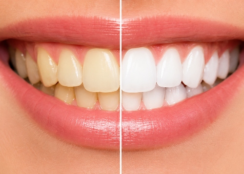 Blessed Smile- Cosmetic Dentistry Teeth Whitening