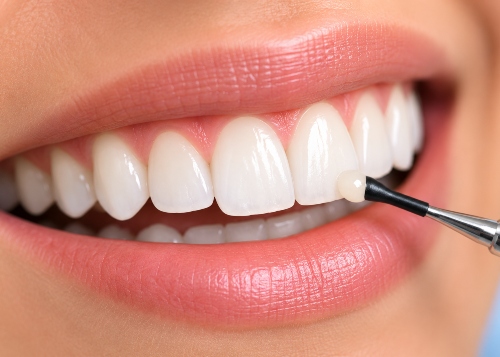 Blessed Smile- Cosmetic Dentistry- bonding