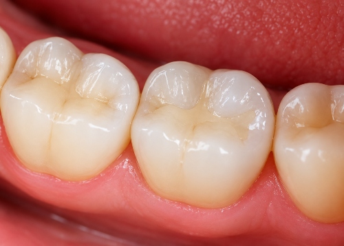 Blessed Smile- Cosmetic Dentistry- Fillings